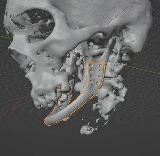 3D - modeling of medical implants