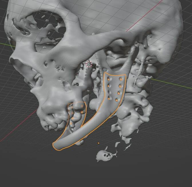 3D - modeling of medical implants